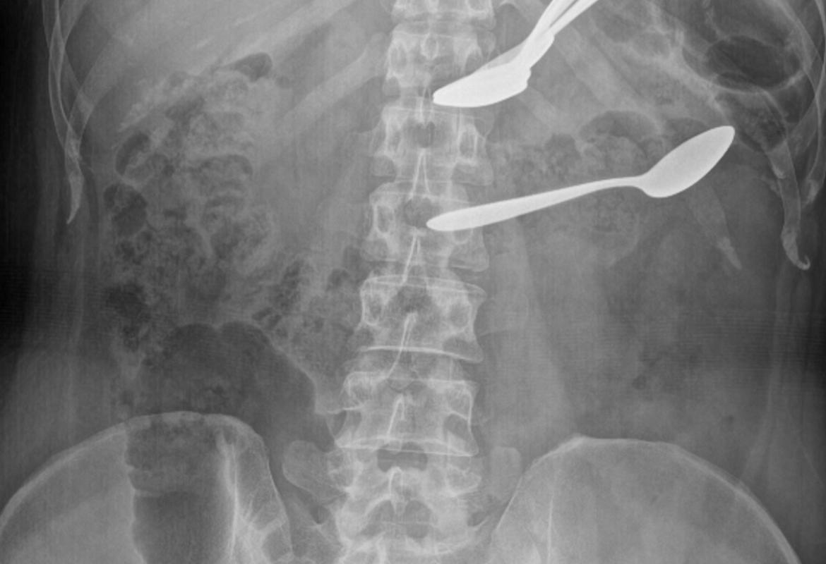 Foreign bodies in the stomach and transverse colon on abdominal X-ray