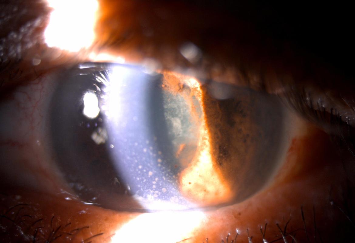 Anterior segment of the left eye with keratic precipitates, seclusio pupillae and dense cataracts