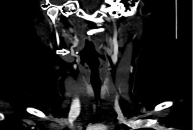 CTA showing tortuosity of right extracranial ICA at level C2 (white arrow)