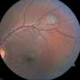 Post-treatment fundus of left eye