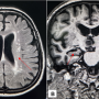 Non-contrast MRI of the patient’s brain showing generalised cortical atrophy (yellow arrows) and loss of hippocampal volume (red arrows) in (A) FLAIR image and (B) Coronal T1 image of the patient’s brain. These structural changes were consistent with neurodegenerative patterns observed in Alzheimer's disease. 
