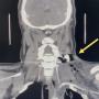 FIGURE 1: Yellow arrow in coronal cut of CECT neck showed hyperdense foreign body measuring 1.8 x 2.8 x 2.5 cm in the left posterior cervical soft tissue at the C5-C6 level