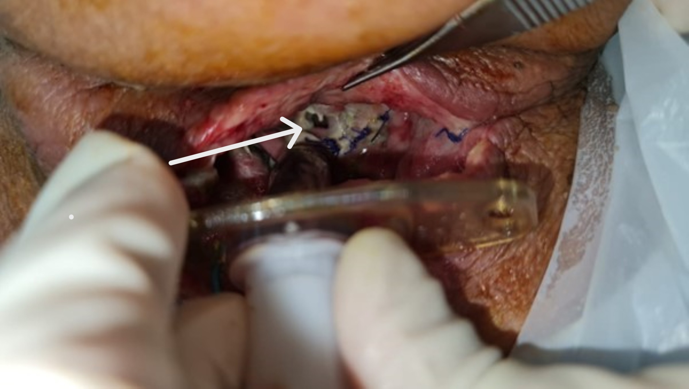 Tracheal dehiscence (white arrow) and surrounding slough just above the tracheostomy tube.