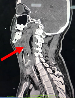 Initial computed tomograpgy neck showed extensive multiloculated gas containing collection seen at retropharyngeal region (red arrow) from the level of oropharynx in sagittal section