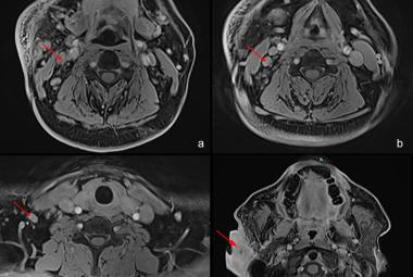 FIGURE 2: MRI images showed (a-c) enlarged and enhancing lymph nodes at levels 2, 3, and 4 of the right cervical neck regions; (d) lobulated soft tissue mass measuring 2.6 cm x 4.9 cm x 6.3 cm in the right pre- and postauricular space