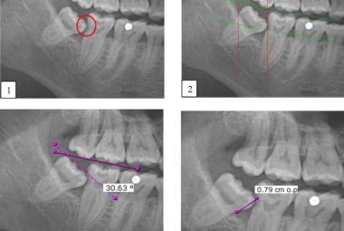 Caries and impacted MTM impaction: (1) Distal caries on MSM; (2) The depth and space of MTM was determined by the Pell & Gregory classification method; (3) The Shiller classification applied in determining the angulation of impacted third molar; (4) The distance between the distal CEJ of the MSM and mesial CEJ of the MTM was calculated as described in Leone classification