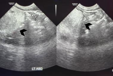 Abdominal ultrasound showed a large lobulated hyperechoic mass occupying abdomen and pelvis (black arrowhead)