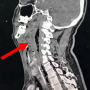 Initial computed tomograpgy neck showed extensive multiloculated gas containing collection seen at retropharyngeal region (red arrow) from the level of oropharynx in sagittal section