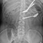 Foreign bodies in the stomach and transverse colon on abdominal X-ray