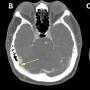 FIGURE 1: (A) Non-contrast CT brain demonstrated acute focal hemorrhage at the right occipital lobe withperihemorrhagic hypodensity extending to the right parieto-occipital region; (B) Subsequent CT venography in axial plane revealed thin linear isodensity within the right transverse sinus; (C) CT venography in coronal plane confirmed the filling defect within the right transverse sinus, consistent with thrombus